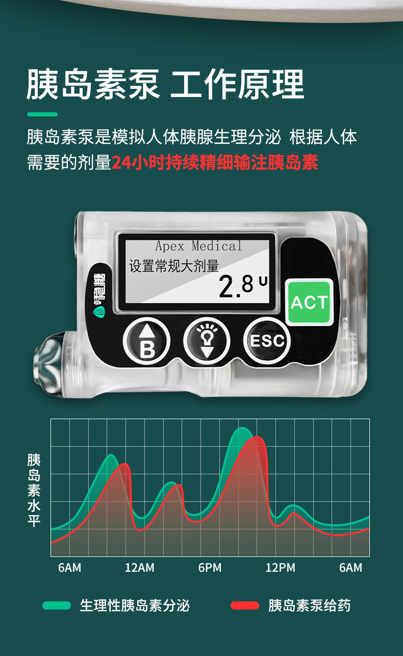 最新全自動(dòng)胰島素泵，糖尿病管理的革命性進(jìn)步，全自動(dòng)胰島素泵，糖尿病管理的突破性革新