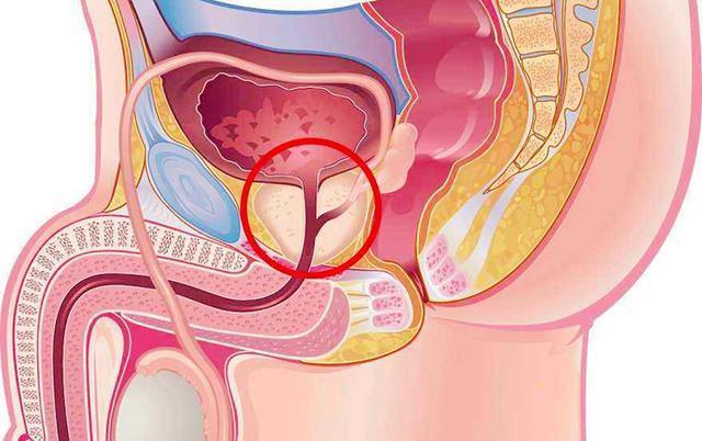 男性前列腺肥大，了解、識(shí)別與應(yīng)對(duì)，男性前列腺肥大，全面解析與應(yīng)對(duì)之道