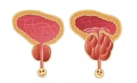 老公的前列腺增大挑戰(zhàn)，理解、支持與共同對抗，老公前列腺增大，理解、支持與共同應(yīng)對的挑戰(zhàn)