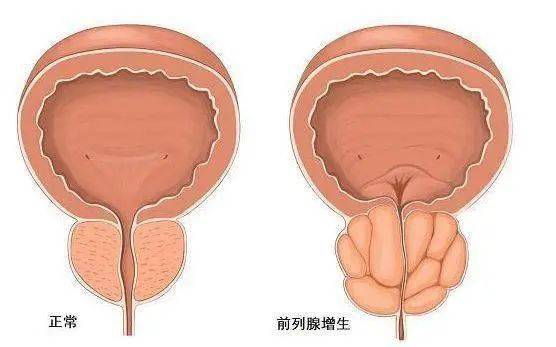 前列腺鈣化，一種常見的前列腺疾病及其相關(guān)知識解析，前列腺鈣化解析，常見疾病與相關(guān)知識探討