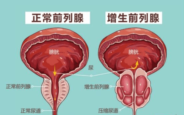 前列腺增生大小標(biāo)準(zhǔn)，理解其關(guān)鍵要素與影響，前列腺增生大小標(biāo)準(zhǔn)詳解，關(guān)鍵要素與影響因素解析