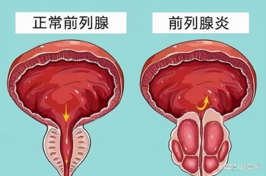 男性前列腺炎的癥狀解析，男性前列腺炎的癥狀詳解