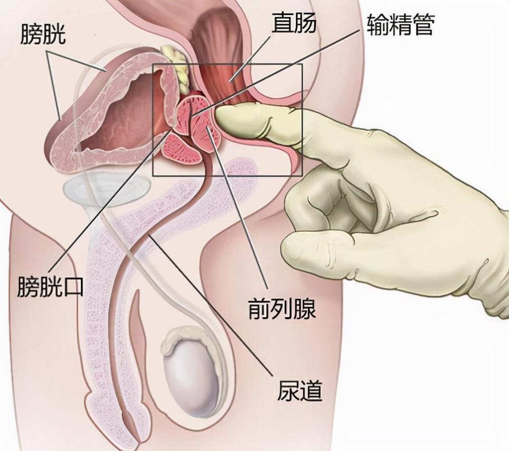 前列腺炎，重新認(rèn)識男性健康的誤區(qū)，重新認(rèn)識男性健康誤區(qū)，前列腺炎解析