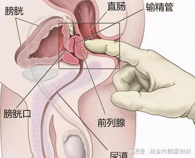 慢性前列腺炎，能否徹底治愈？解析與探討，慢性前列腺炎的治愈可能性解析與探討