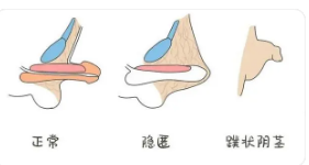 關(guān)于做包皮手術(shù)的費用分析，包皮手術(shù)費用詳解