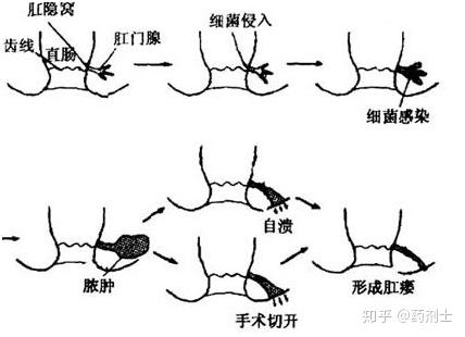 陽(yáng)瘺