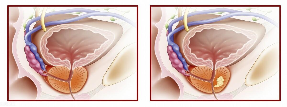 前列腺鈣化，揭示其潛在危害，前列腺鈣化，潛在危害揭秘