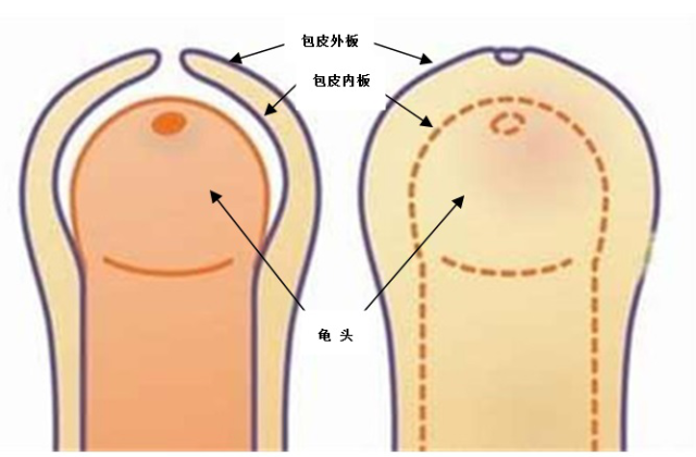 包莖及其相關圖片，了解、識別與處理，包莖詳解，圖片、識別、處理方法全攻略