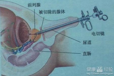 如何控制前列腺增生，如何控制前列腺增生的發(fā)展及癥狀？