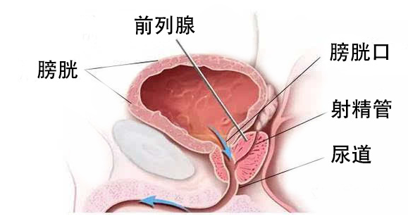 普樂(lè)安片治療前列腺炎的療程與效果，深度解析，普樂(lè)安片治療前列腺炎療程與效果深度解析，療程長(zhǎng)短與治療效果一覽無(wú)余。