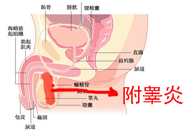 附睪炎，絕望中的希望曙光，附睪炎，絕望中的希望之光