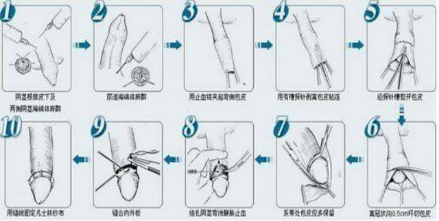 大人環(huán)切手術(shù)后恢復(fù)圖